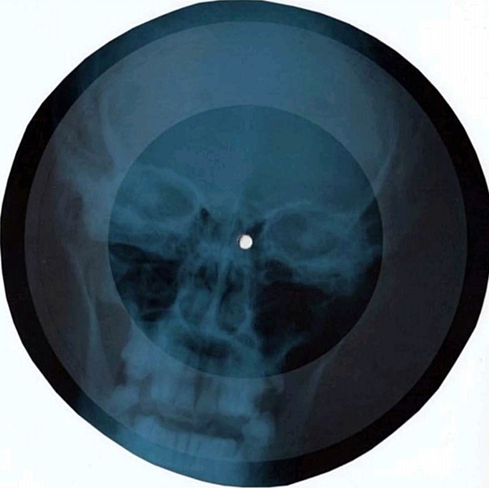 Soviet Russian Underground X-Ray Music Bone Record